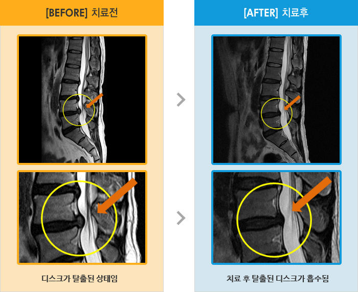 자생한방병원 치료사례 MRI로 보는 치료결과-허리 통증과 간헐적으로 오른쪽 허벅지 찌릿함