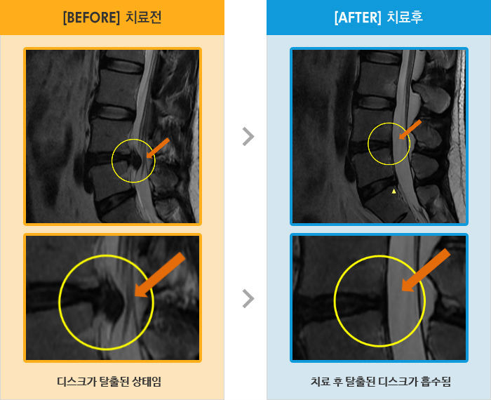 자생한방병원 치료사례 MRI로 보는 치료결과-허리가 통증으로 틀어져있고 오른쪽 다리 통증