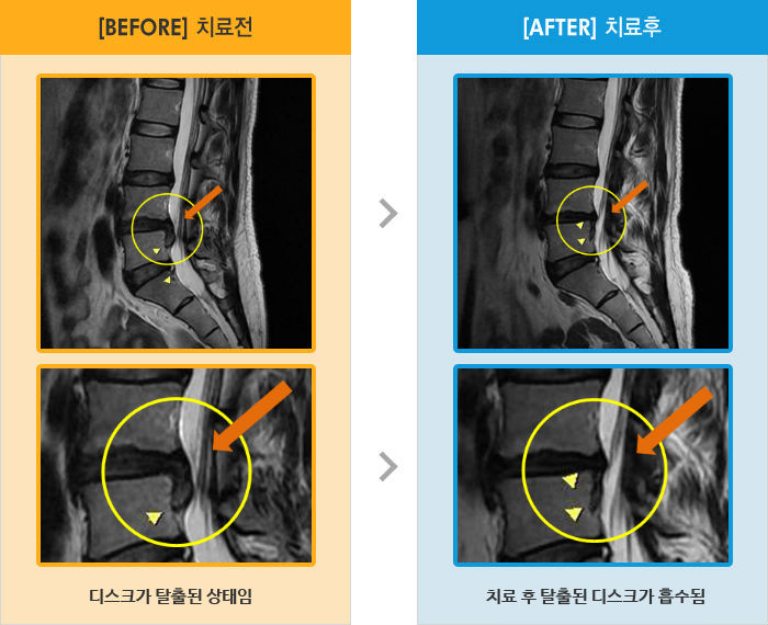 자생한방병원 치료사례 MRI로 보는 치료결과-허리와 왼쪽 다리 통증