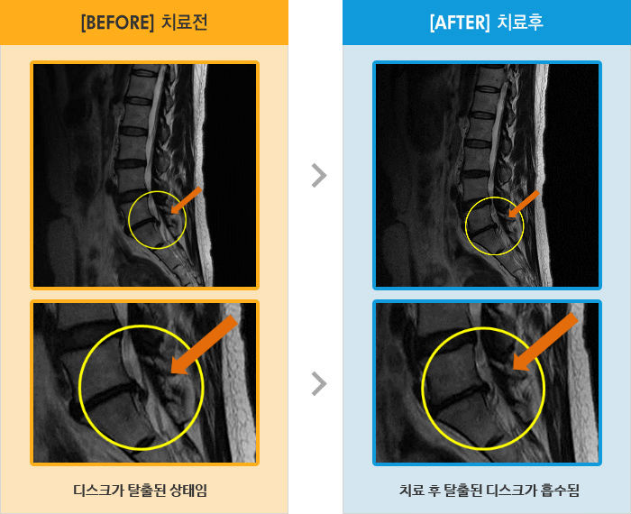 자생한방병원 치료사례 MRI로 보는 치료결과-왼쪽 엉덩이와 오금 통증이 있어 보행시 심함