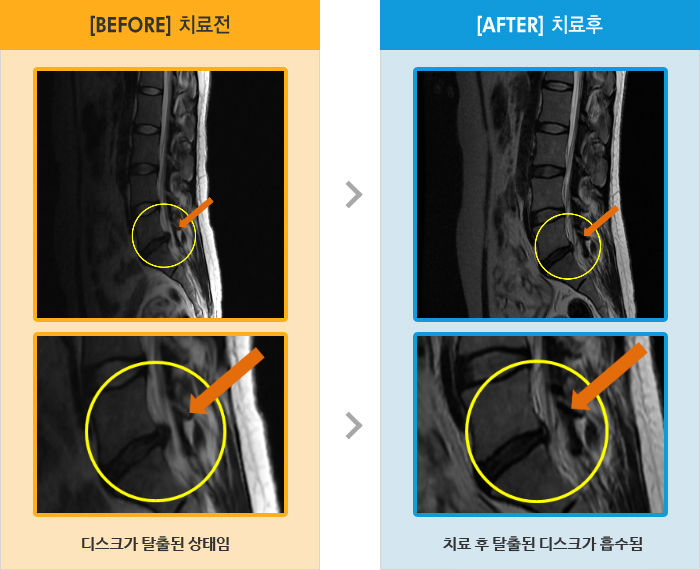 자생한방병원 치료사례 MRI로 보는 치료결과-서있는 자세와 바로 누운 자세에서 허리통증 및 왼쪽 다리 저림