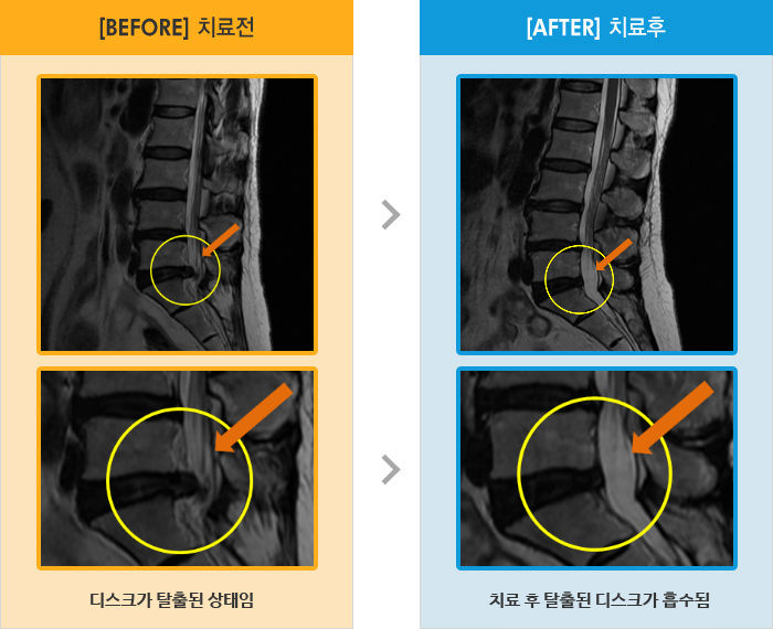 자생한방병원 치료사례 MRI로 보는 치료결과-허리를 숙인 상태로 유지해야 아프지 않음