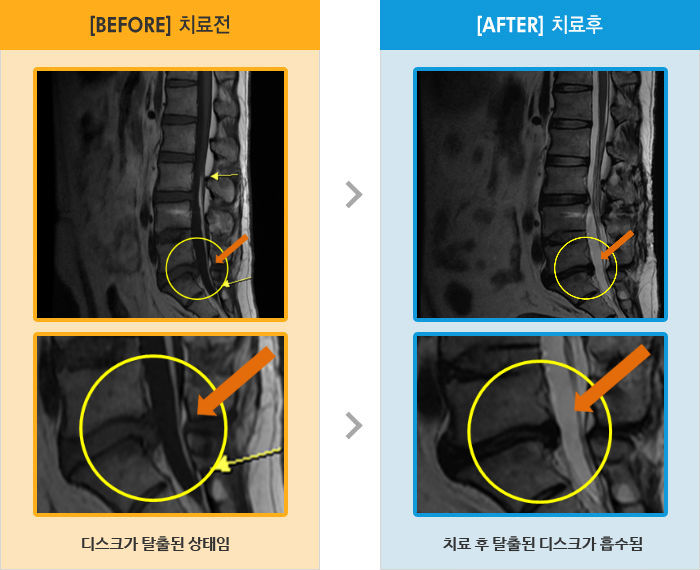자생한방병원 치료사례 MRI로 보는 치료결과-허리와 오른쪽 다리 통증, 자세 변경시 통증