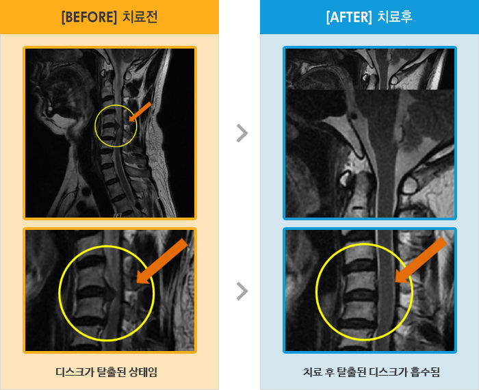 자생한방병원 치료사례 MRI로 보는 치료결과-서있거나 앉아있을 때 통증, 야간통과 좌측 어깨, 팔, 손가락 끝까지 저림