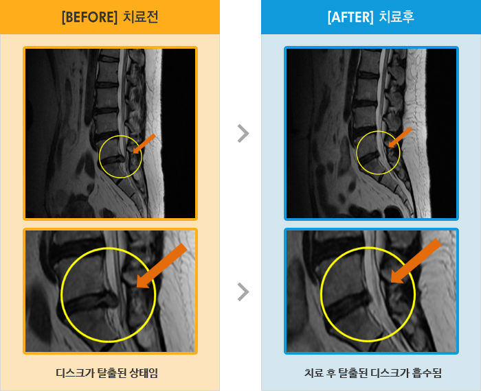 자생한방병원 치료사례 MRI로 보는 치료결과-허리와 왼쪽 다리 통증