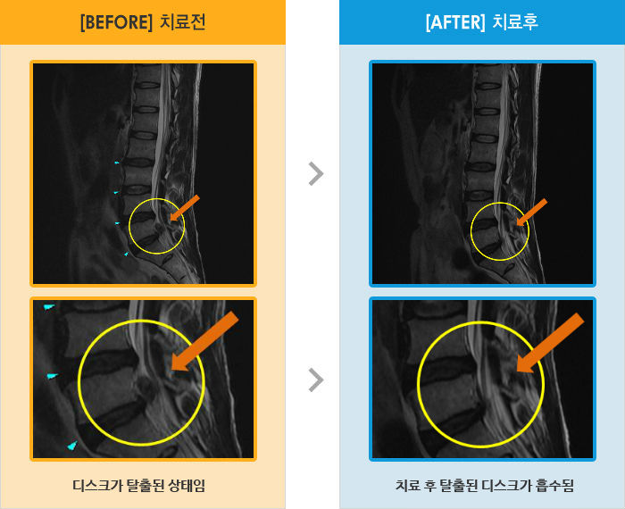자생한방병원 치료사례 MRI로 보는 치료결과-오른쪽 골반과 종아리 통증