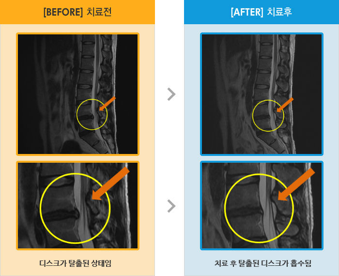 자생한방병원 치료사례 MRI로 보는 치료결과-허리 가운데로 통증