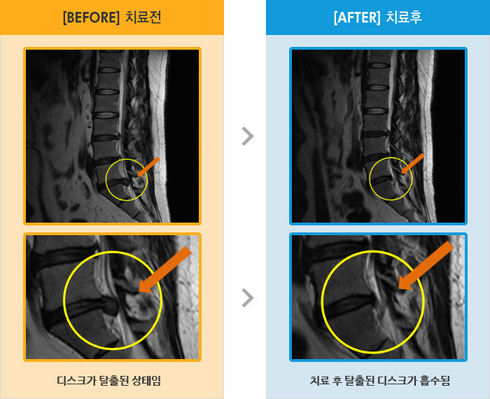 자생한방병원 치료사례 MRI로 보는 치료결과-우측 엉덩이,허벅지,종아리에서 발목까지 통증