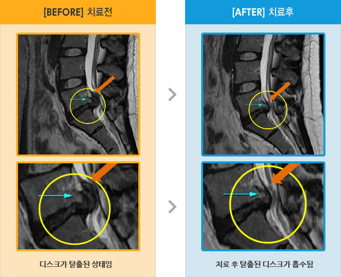 자생한방병원 치료사례 MRI로 보는 치료결과-옆으로 누울 때와 서있을때 다리 저림