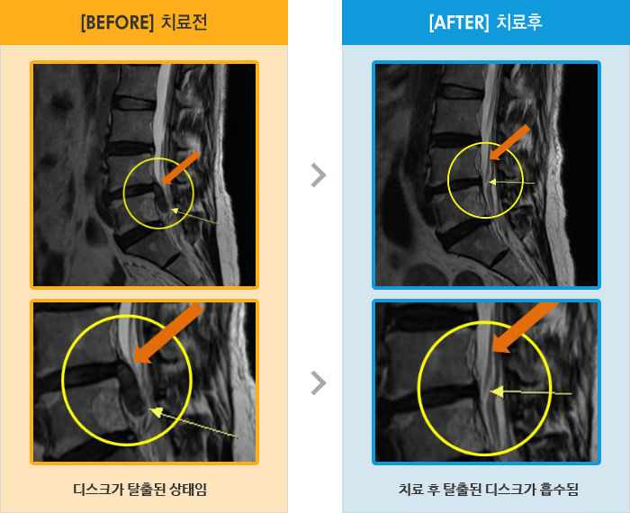 자생한방병원 치료사례 MRI로 보는 치료결과-좌측 허리부터 발끝까지 저리고, 당김