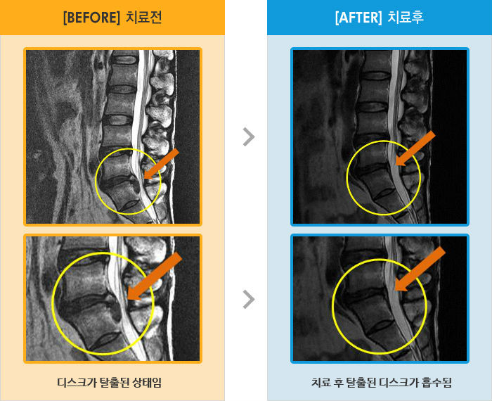 자생한방병원 치료사례 MRI로 보는 치료결과-앉아있다 일어날 때와 허리 굽힐 때 통증