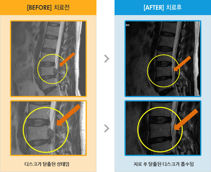 자생한방병원 치료사례 MRI로 보는 치료결과-허리 왼쪽과 엉덩이의 통증, 저림 증상