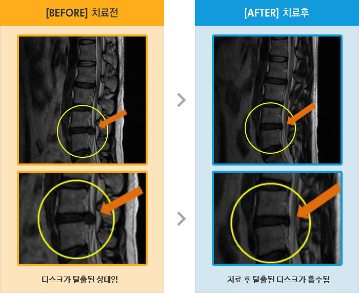 자생한방병원 치료사례 MRI로 보는 치료결과-양측 골반통증으로 자세변경 시 통증