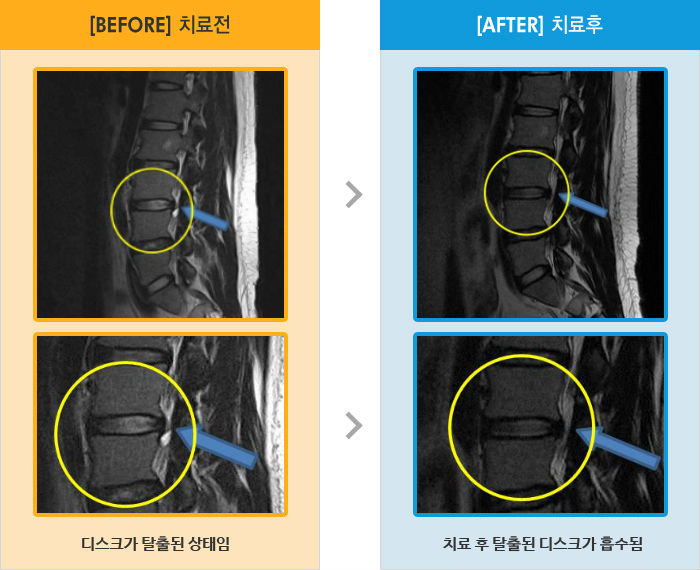 자생한방병원 치료사례 MRI로 보는 치료결과-왼쪽 다리 통증과 저림