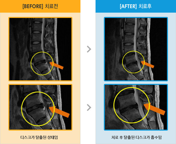 자생한방병원 치료사례 MRI로 보는 치료결과-오른쪽 엉덩이 다리 통증