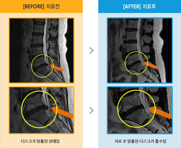 자생한방병원 치료사례 MRI로 보는 치료결과-앉아 있을때 왼쪽 엉덩이 통증, 발 뒤꿈치 저림