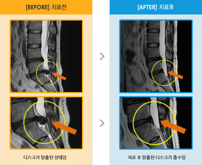 자생한방병원 치료사례 MRI로 보는 치료결과-허리 오른쪽 엉덩이 허벅지가 당기고 찌릿한 통증