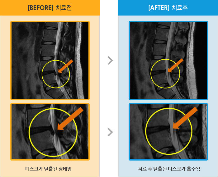 자생한방병원 치료사례 MRI로 보는 치료결과-허리통증, 좌측 엉치저림, 우측 허리통증