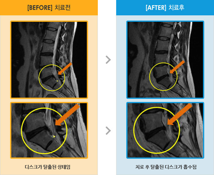자생한방병원 치료사례 MRI로 보는 치료결과-골반 양측 통증과 왼쪽 다리 저림