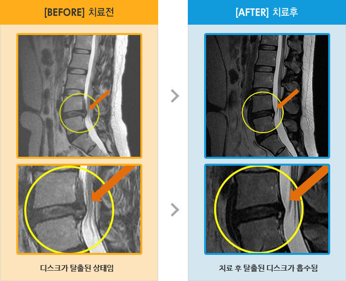 자생한방병원 치료사례 MRI로 보는 치료결과-골반통증과 오른쪽 엉치 허벅지 저린감, 마비감