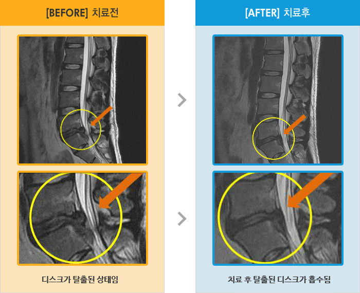자생한방병원 치료사례 MRI로 보는 치료결과-허리를 숙이거나 누울때 통증