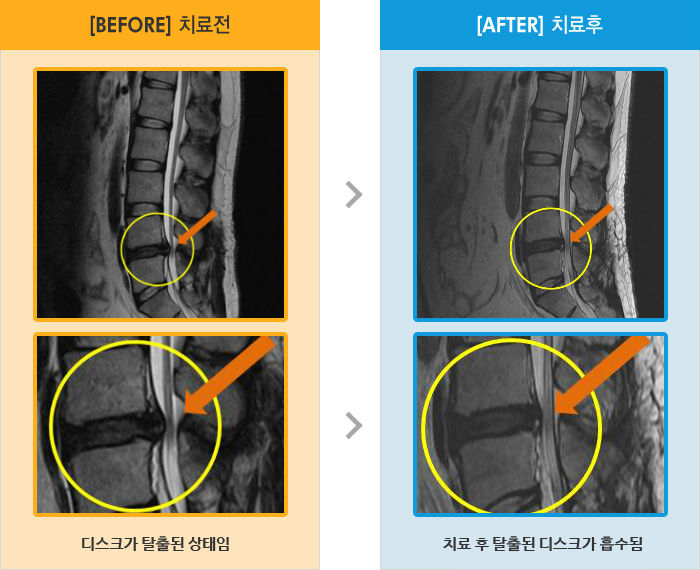 자생한방병원 치료사례 MRI로 보는 치료결과-허리 통증과 좌우 양측 다리 저림