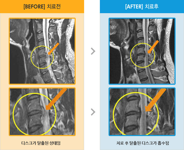 자생한방병원 치료사례 MRI로 보는 치료결과-머리 뒤쪽  통증이 있었고 오른쪽 팔 감각 무딤