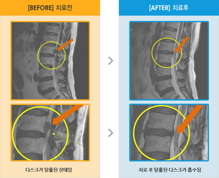 자생한방병원 치료사례 MRI로 보는 치료결과-일어서서 걸을때 왼쪽 엉덩이 무릎 발목 통증