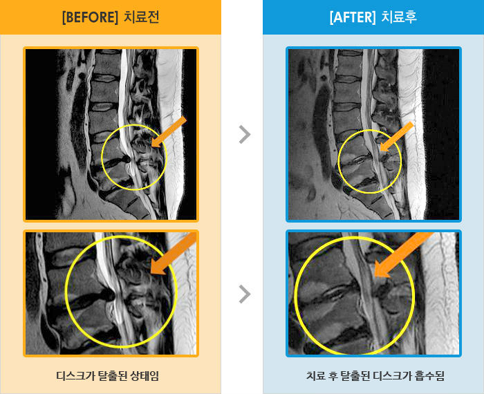 자생한방병원 치료사례 MRI로 보는 치료결과-보행시 왼쪽 골반 통증, 왼다리 저림