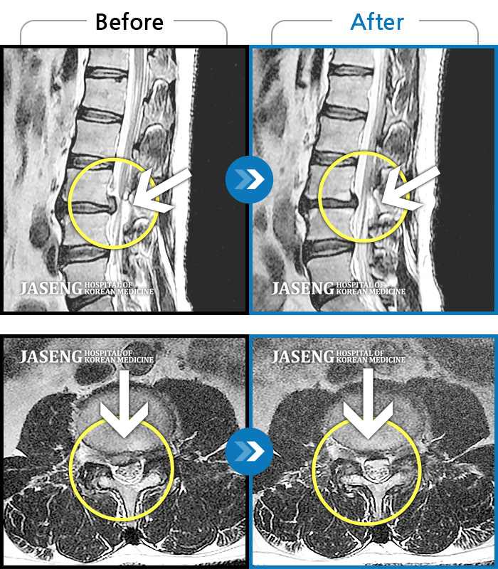 자생한방병원 치료사례 MRI로 보는 치료결과-우측 허리와 골반이 통증이 심하고 우측 허벅지 전면으로 통증, 저림이 내려왔다.