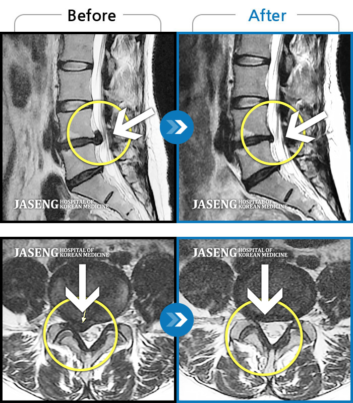 자생한방병원 치료사례 MRI로 보는 치료결과-오른쪽 정강이 감각이 무디고, 발바닥 통증