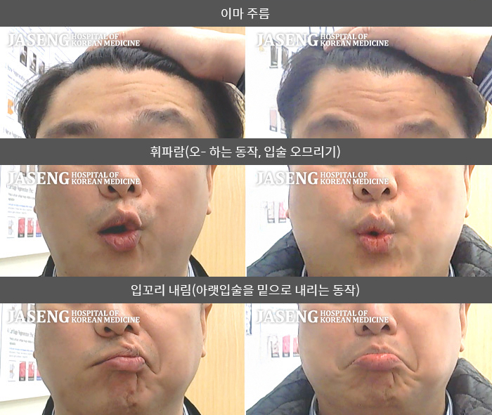 자생한방병원 치료사례 MRI로 보는 치료결과-오른쪽 눈이 안감기고 귀 뒤쪽 통증이 있고 두통이 심함