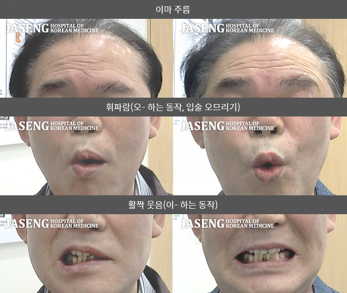 자생한방병원 치료사례 MRI로 보는 치료결과-좌측 눈이 안감기고 눈물이 남.  좌측 귀 뒤가 아프면서 좌측으로 입이 마비됨