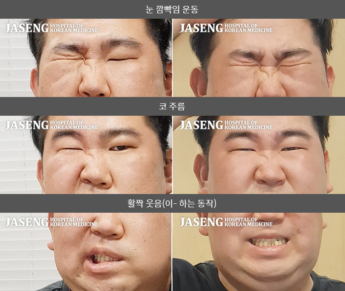 자생한방병원 치료사례 MRI로 보는 치료결과-왼쪽 눈이 잘 안 감기고 왼쪽 안면부 전체 마비된 느낌이다. 