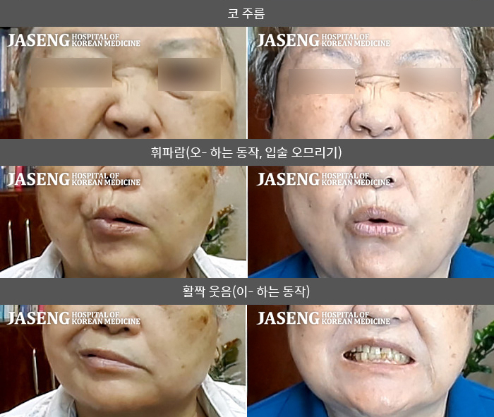 자생한방병원 치료사례 MRI로 보는 치료결과-한방치료만으로 회복한 안면마비