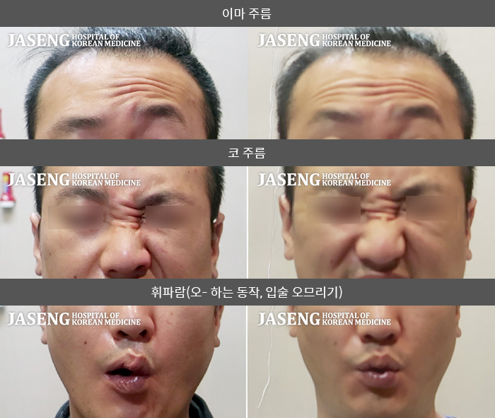 자생한방병원 치료사례 MRI로 보는 치료결과-미각 저하와 편두통, 우측 상지 저림 증상이 동반 된 우측 안면마비가 입원 집중치료 2주 만에 호전