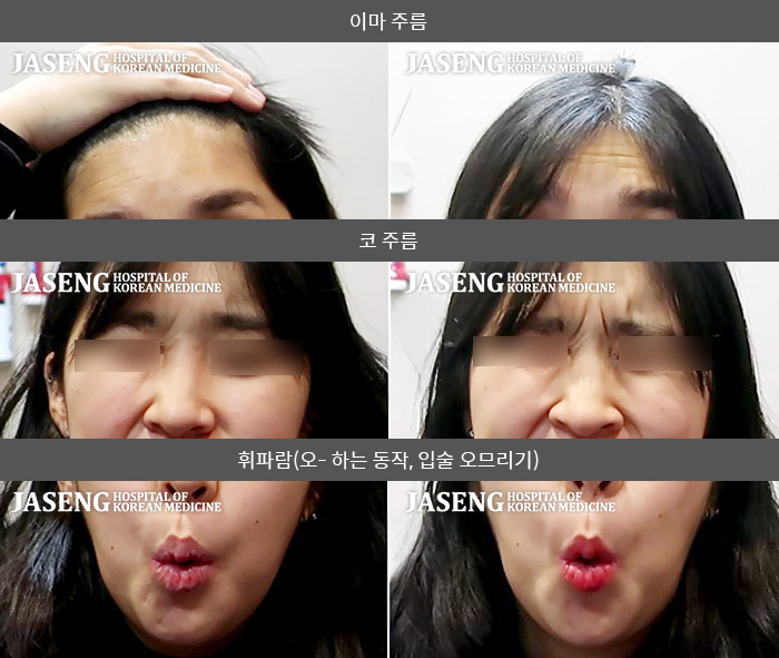 자생한방병원 치료사례 MRI로 보는 치료결과-새 직장에 입사 후 찬바람에 노출되어 생긴 안면마비