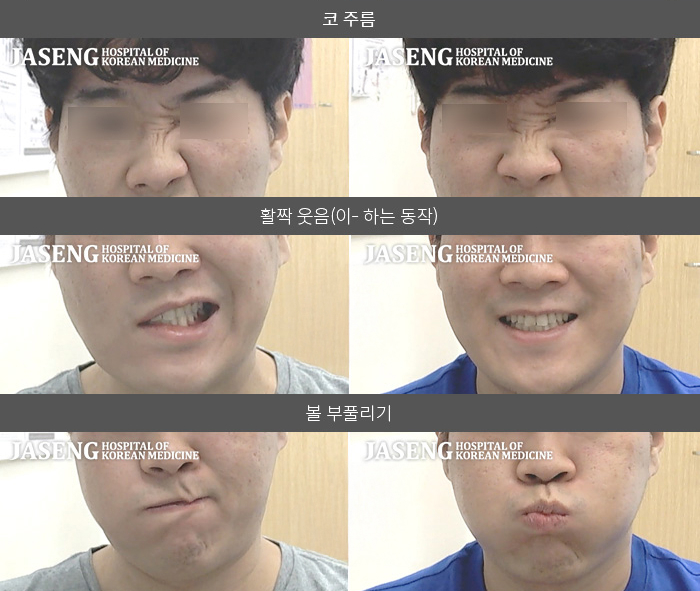 자생한방병원 치료사례 MRI로 보는 치료결과-우측 눈이 안감겨서 불편하고 우측 귀에 청각과민이 생겨 코 풀때 파도소리가 들림 