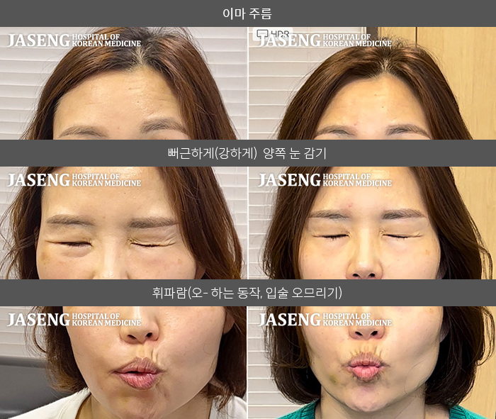 자생한방병원 치료사례 MRI로 보는 치료결과-우측 눈이 안 감긴다. 우측 입 주름이 안 잡힌다. 