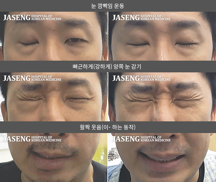 자생한방병원 치료사례 MRI로 보는 치료결과-이유없이 안면마비와 미각이상, 좌측청각과민 동반으로 내원