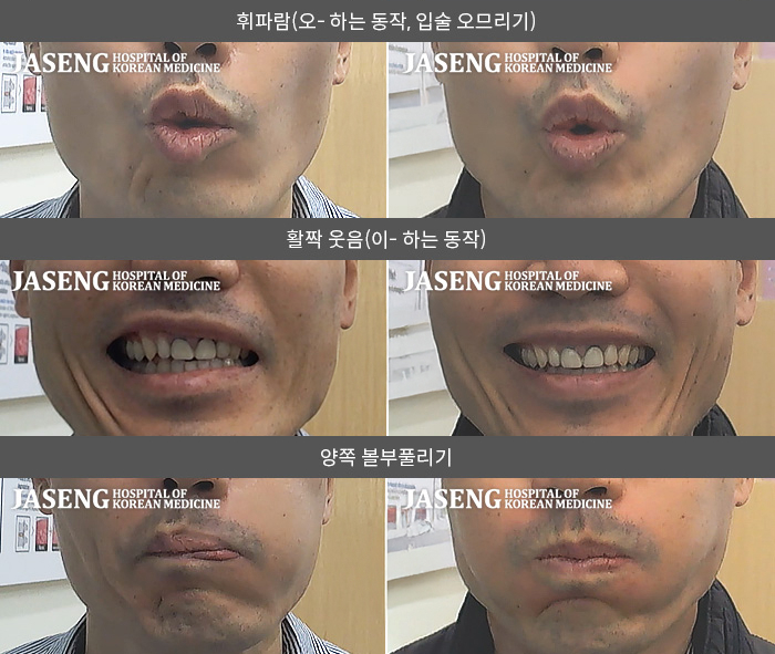 자생한방병원 치료사례 MRI로 보는 치료결과-스트레스로 잠을 못잔 후 안면마비가 발생했습니다.