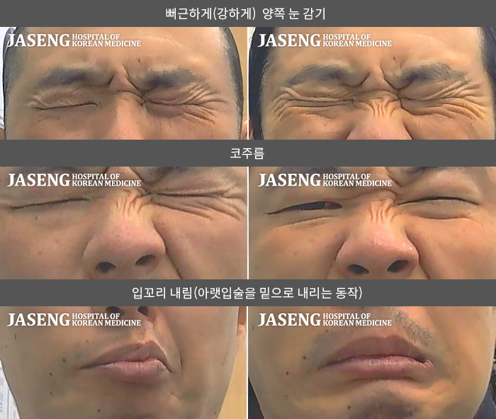 자생한방병원 치료사례 MRI로 보는 치료결과-별무 이유 없이  우측 안면마비 우측 귀뒤 통증 발생해  발병