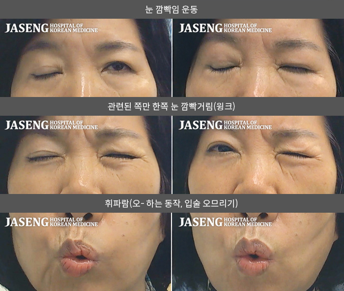 자생한방병원 치료사례 MRI로 보는 치료결과-이유 없이  안면마비  발생해  타 대학병원 brain MRI 촬영및 검사후  좌측 말초성 안면마비 진단 하고 내원 입원 치료함 