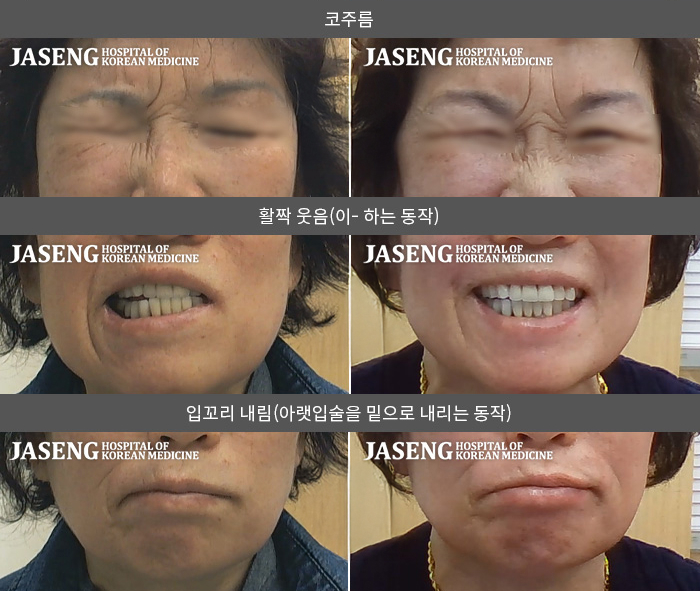 자생한방병원 치료사례 MRI로 보는 치료결과-양치 하면서 좌측 안면마비 인지한 후 본원 내원 하여 치료 시작  