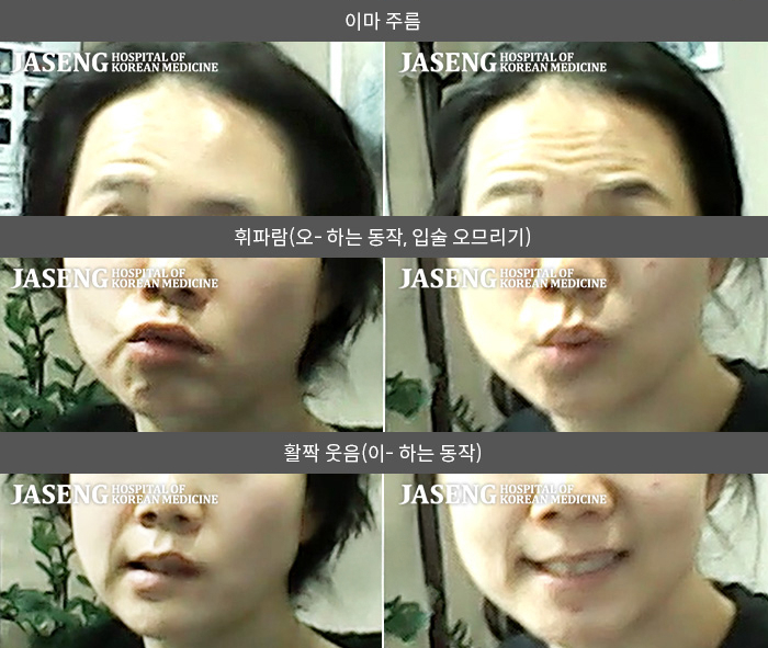 자생한방병원 치료사례 MRI로 보는 치료결과-한쪽 눈이 감기지 않고 좌측 안면부 전체로 마비왔습니다.