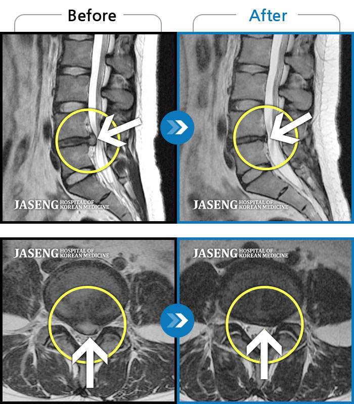 자생한방병원 치료사례 MRI로 보는 치료결과-앉았다 일어날때 통증, 허리 당김