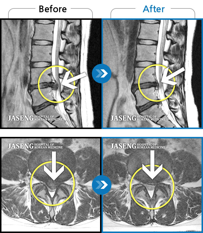 자생한방병원 치료사례 MRI로 보는 치료결과-하요추부 통증, 자가보행이 어렵고 좌측 대퇴부 견인통