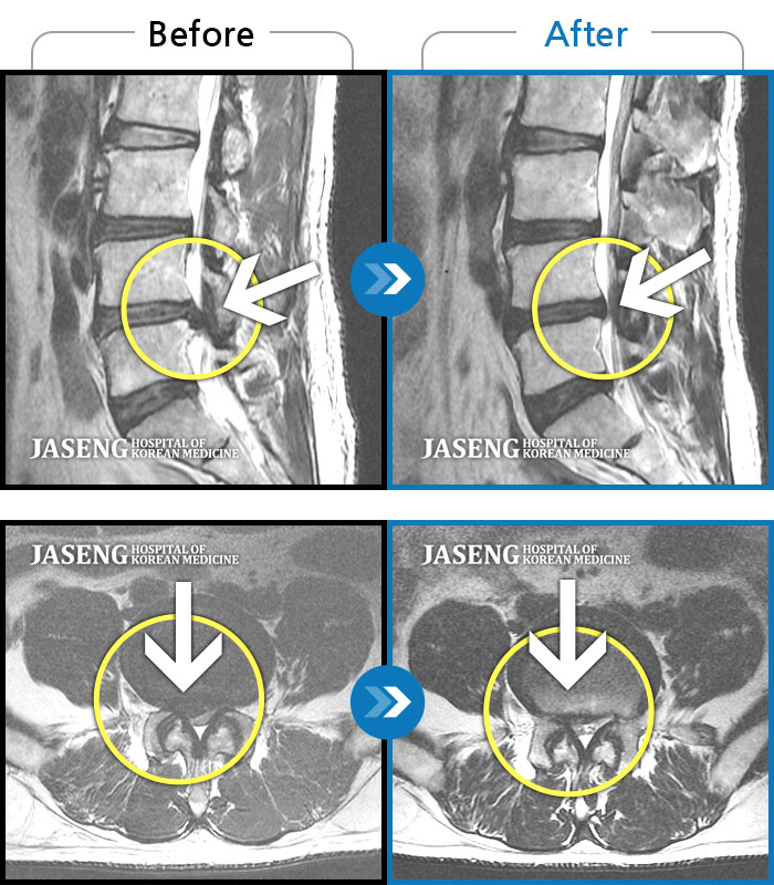 자생한방병원 치료사례 MRI로 보는 치료결과-허리 통증과 우측 다리 통증과 저림