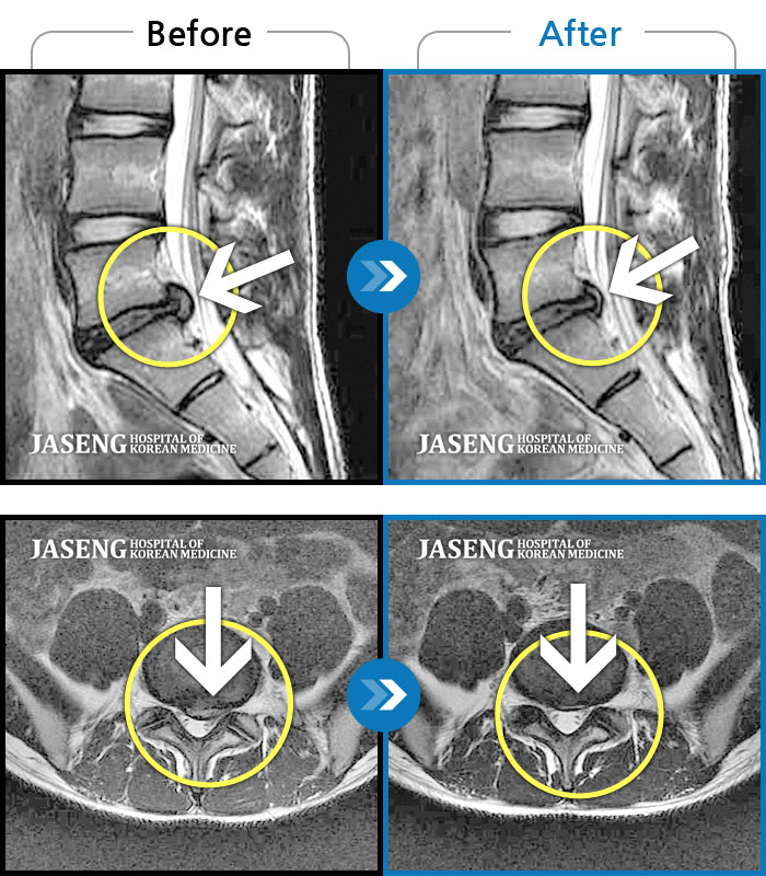 자생한방병원 치료사례 MRI로 보는 치료결과-허리 통증과 좌측 다리 통증