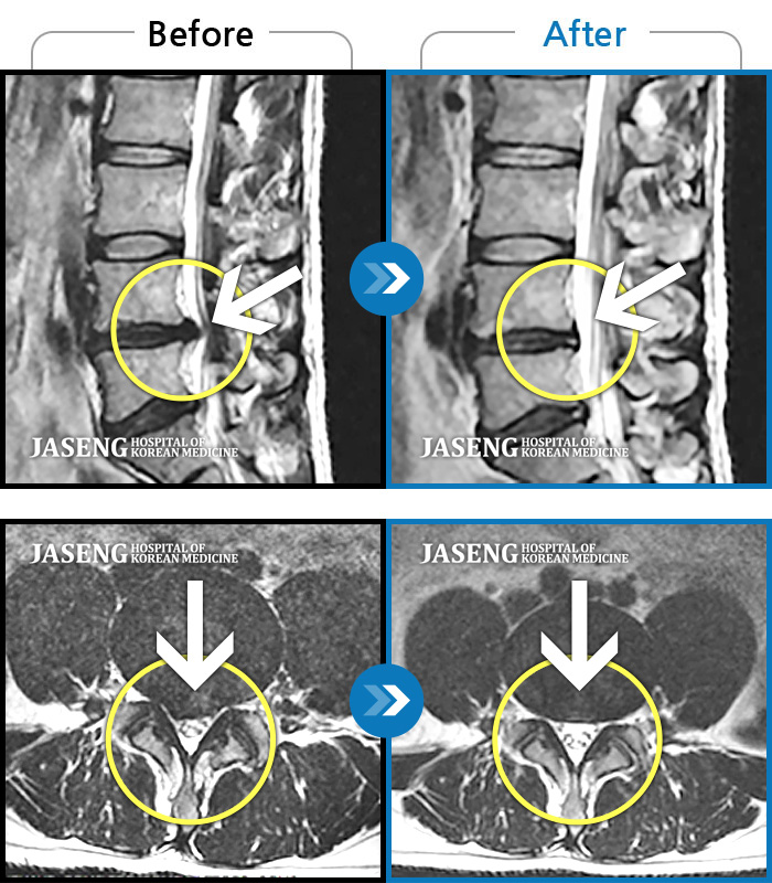 자생한방병원 치료사례 MRI로 보는 치료결과-허리 골반 통증, 오른쪽 다리가 발끝까지 저림